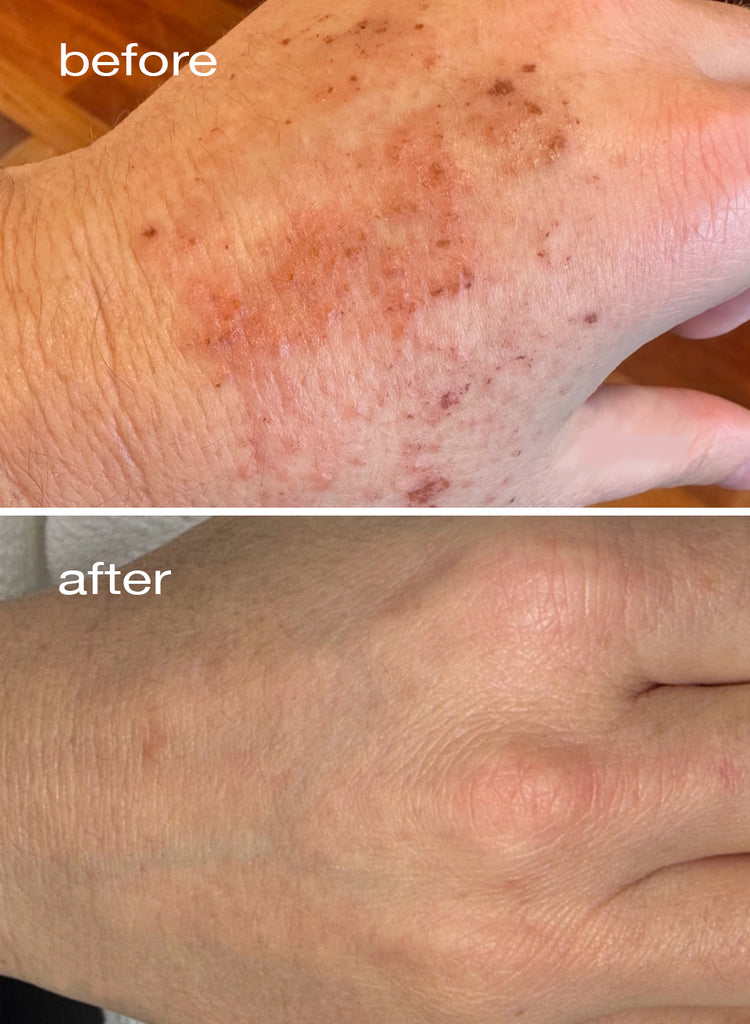 Before and after comparison of a hand with skin conditions .