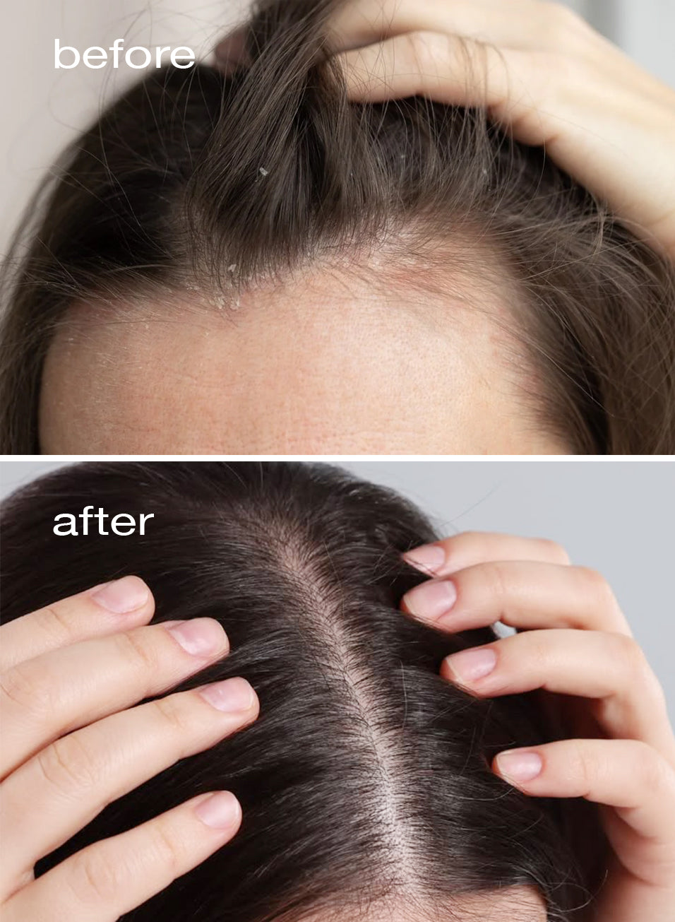 Before and after comparison of a child's head with hair thinning on the scalp.