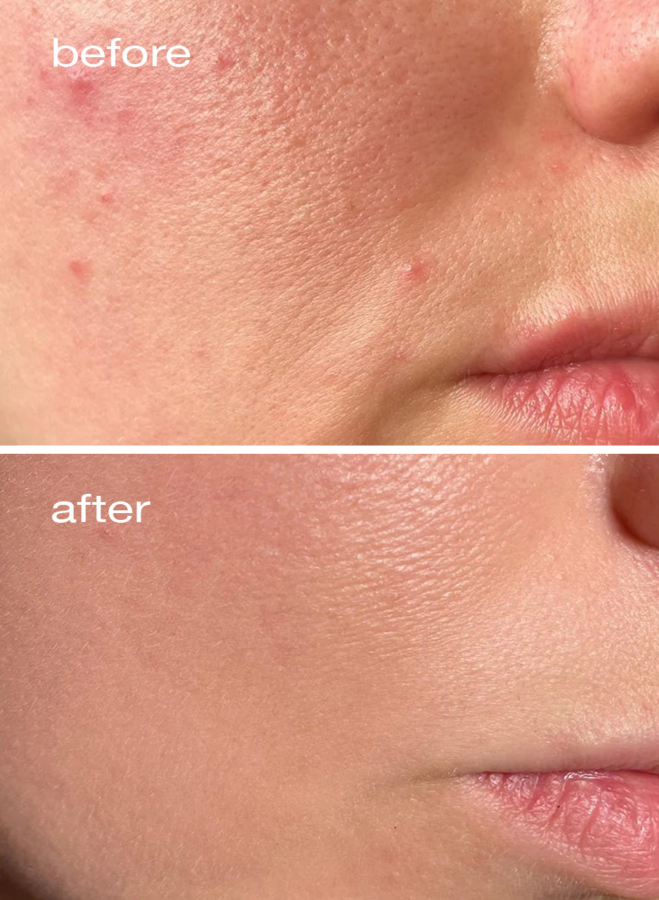 Before and after comparison of skin with acne treatment showing smoother texture.